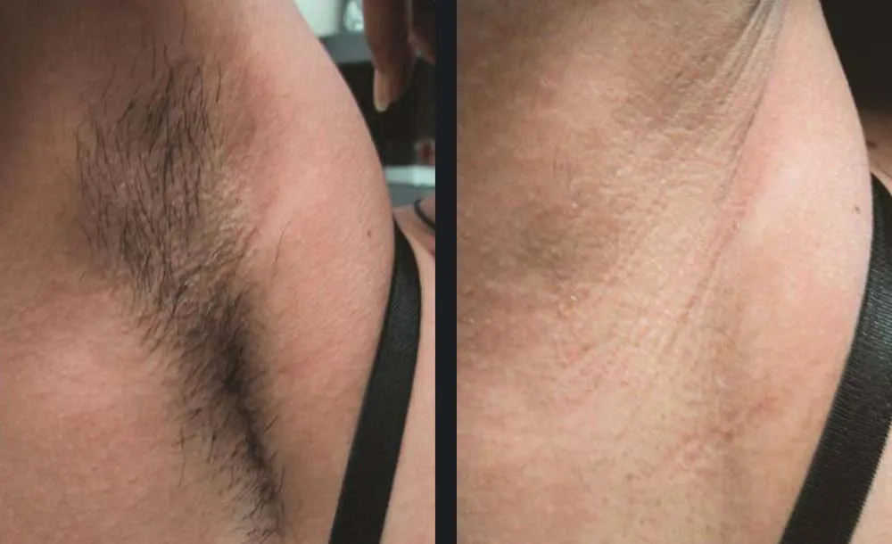 avant après epilation
