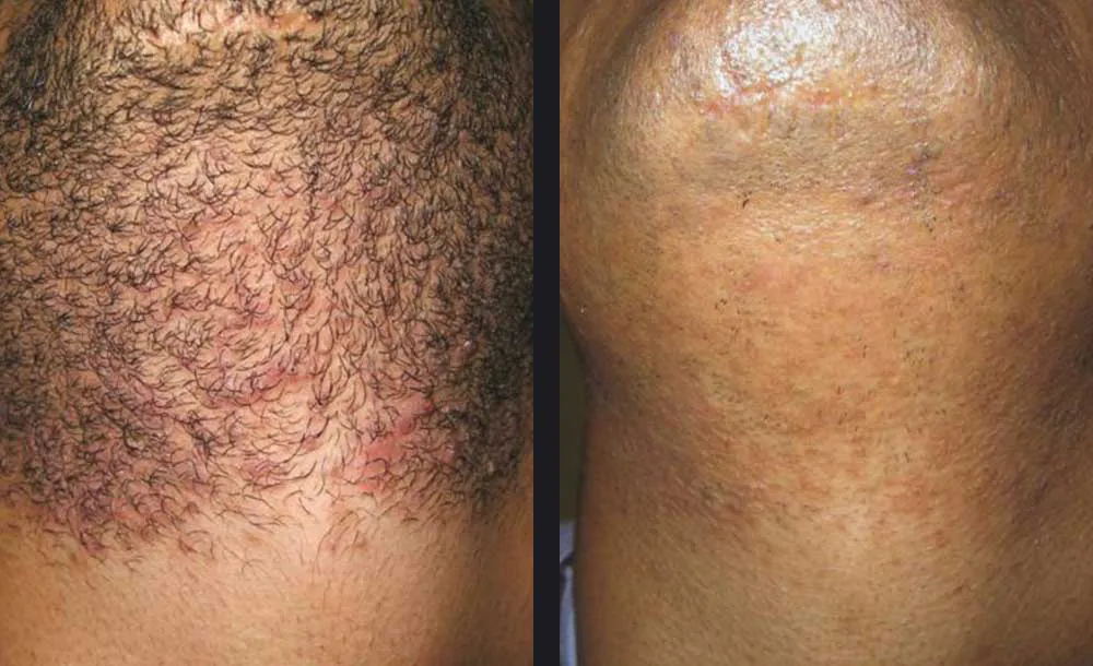 avant après epilation