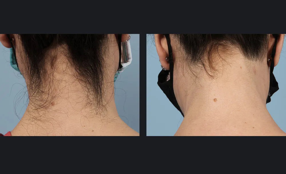 avant après epilation