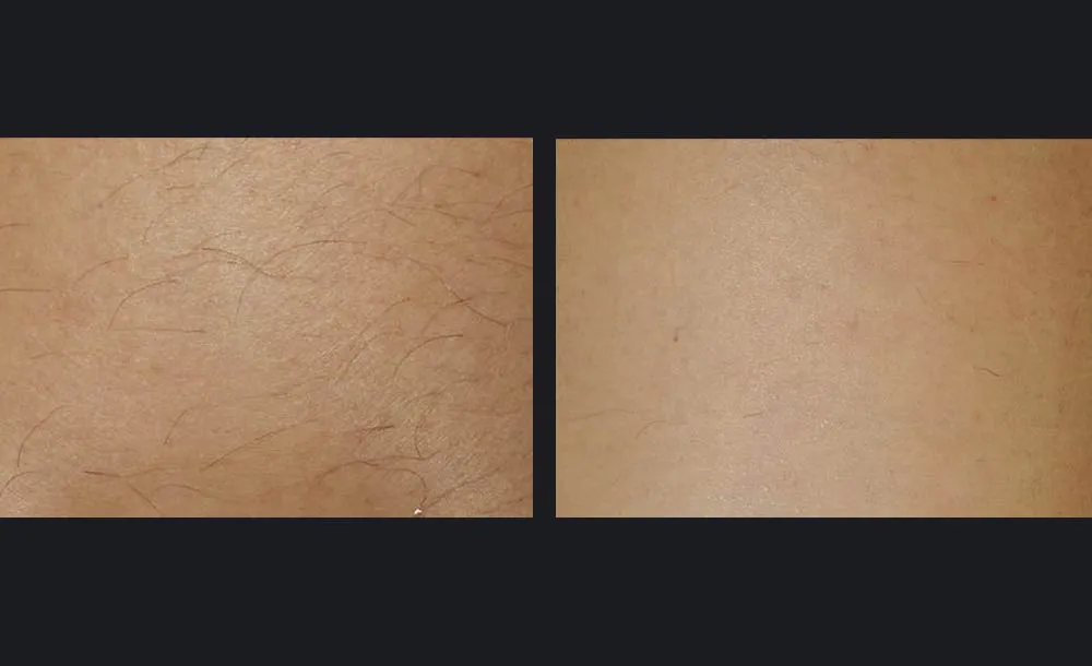 avant après epilation