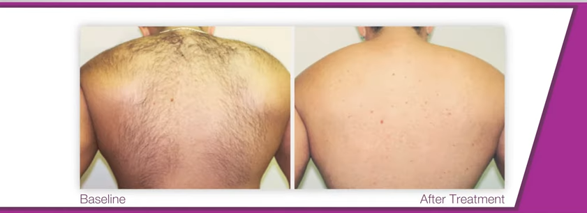 avant après epilation